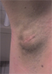 Abszess Axilla rechts